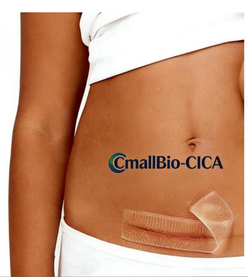 C-Section Hypertrophic Scars အတွက် ဘယ် Scar Patch က အကောင်းဆုံးလဲ။ 2026 ဆေးဘက်ဆိုင်ရာအဆင့် အမာရွတ် Patch ဝယ်ယူခြင်းလမ်းညွှန်